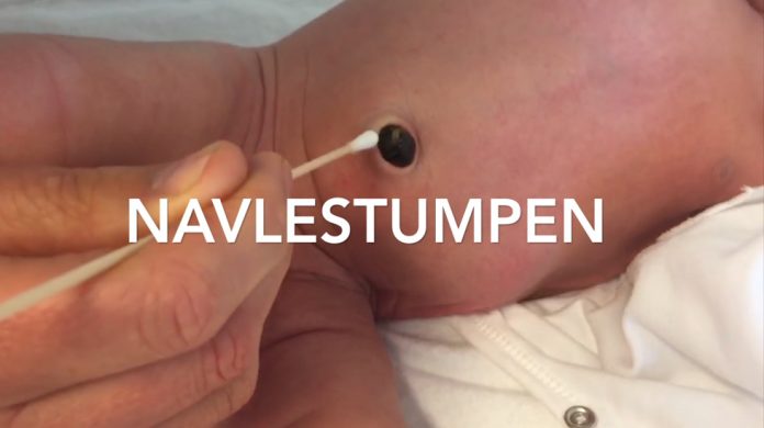 Navlestumpen – slik gjør du